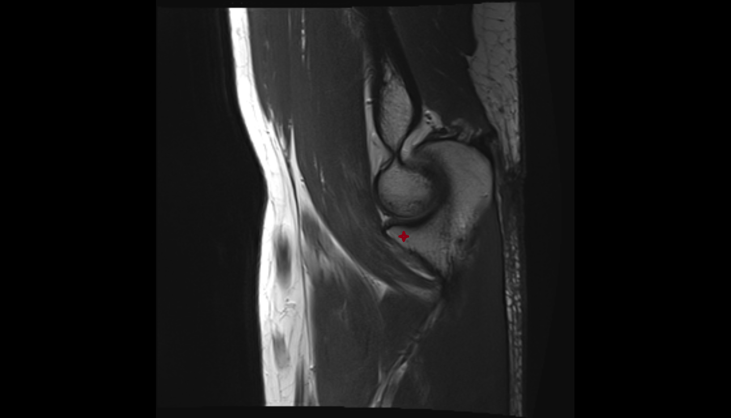 Coronoid process of ulna sag cross sectional anatomy 3T MRI AI enhanced radiology image -img-00000-00000