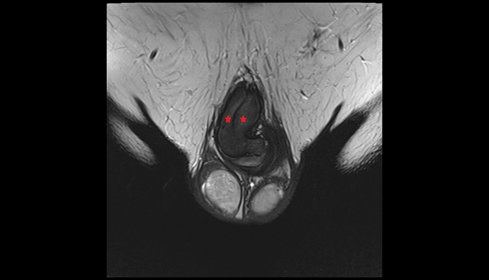 Corpus cavernosum mri coronal image