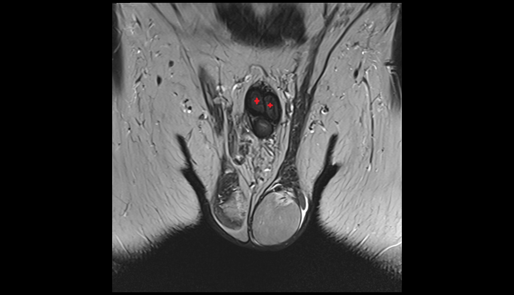 Corpus cavernosum mri coronal image 1