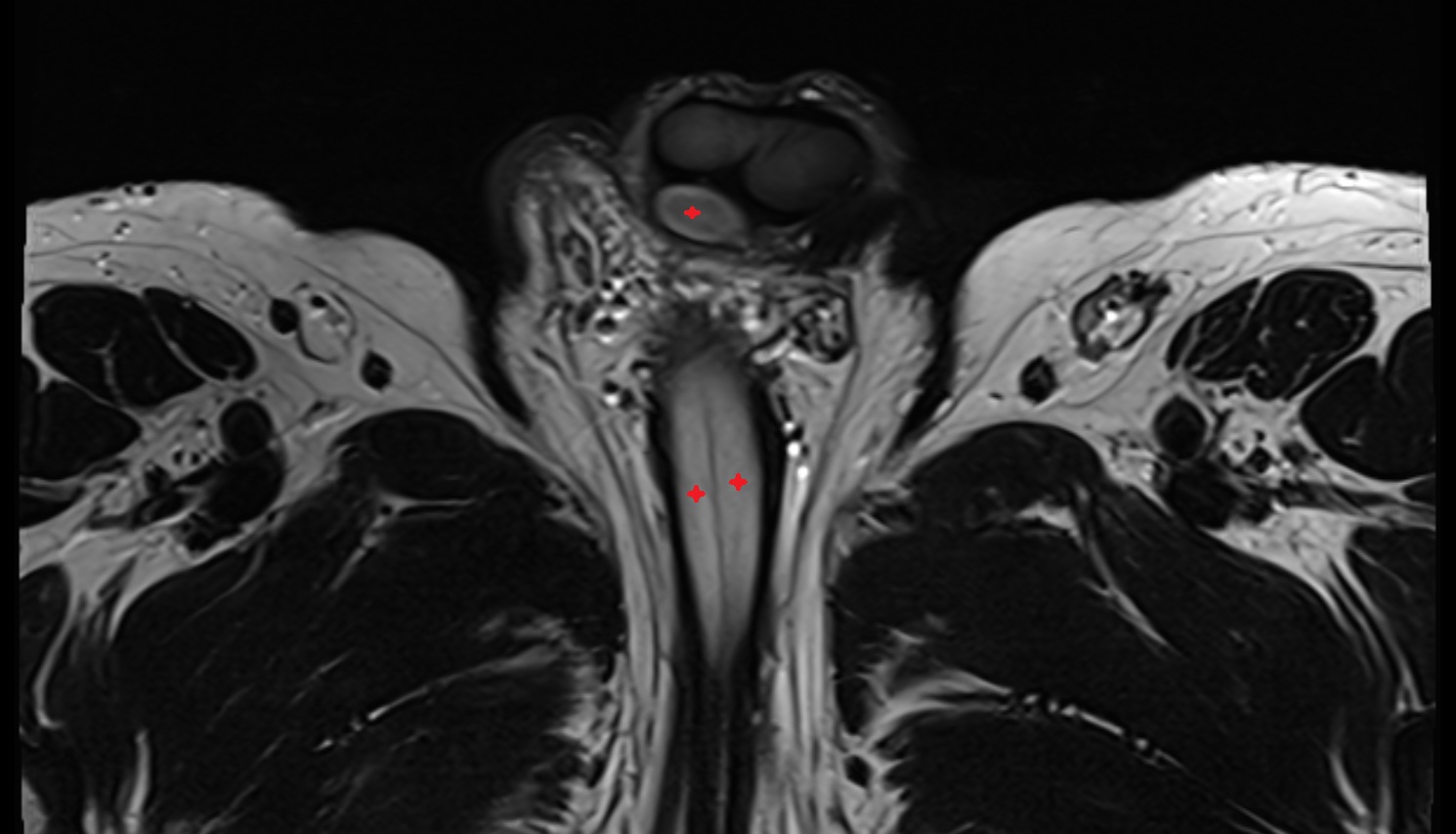 Corpus spongiosum  mri axial  anatomy  image-img-00000-00000