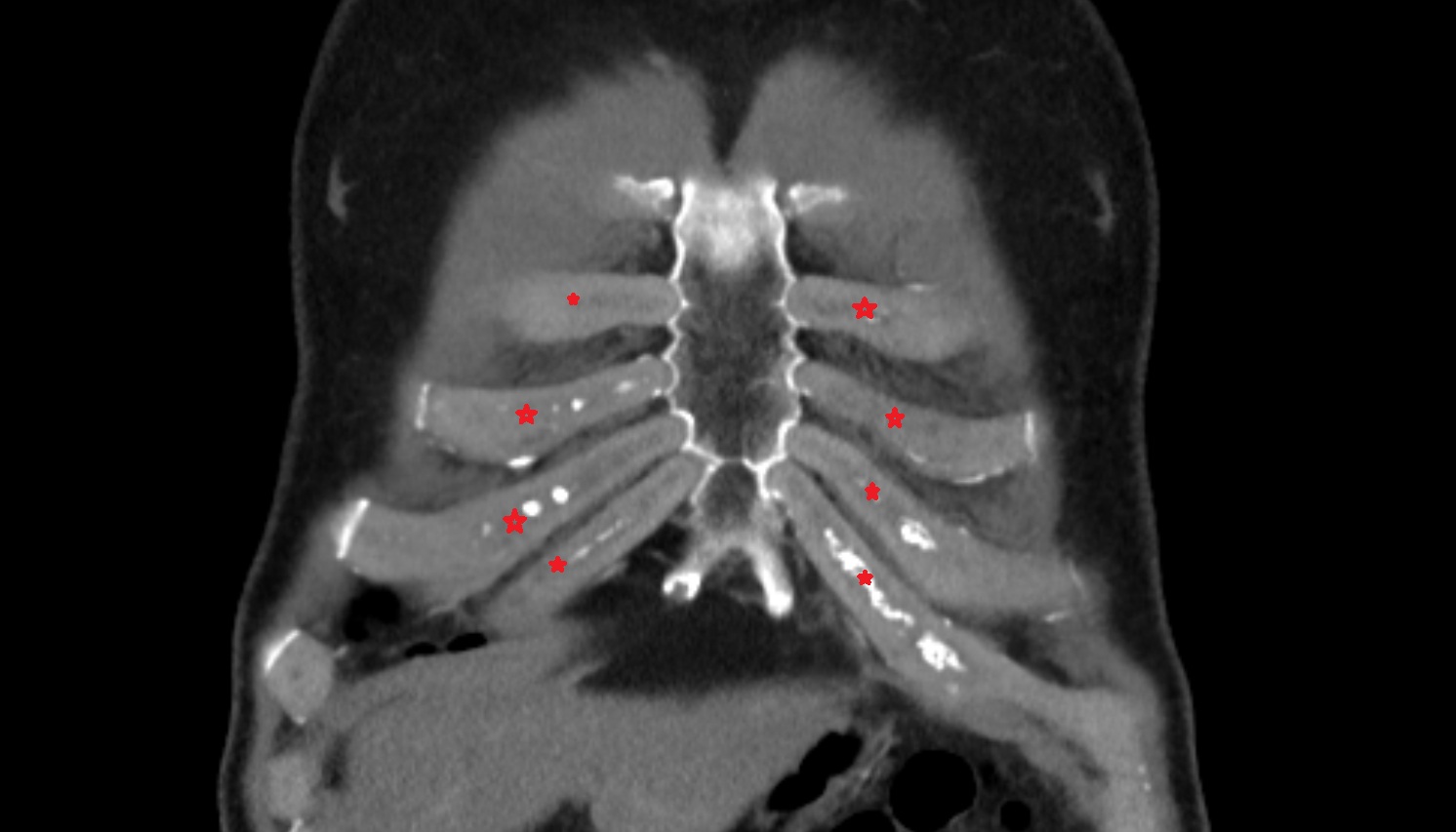 Costal cartilage  anatomy CT CORONAL  image -img-00000-00000