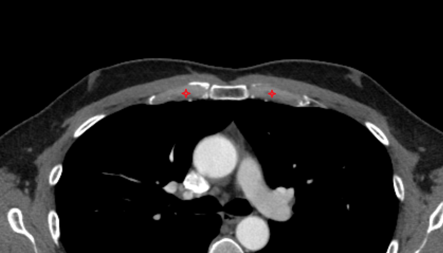 Costal cartilage  anatomy CT axial  image -img-00000-00000