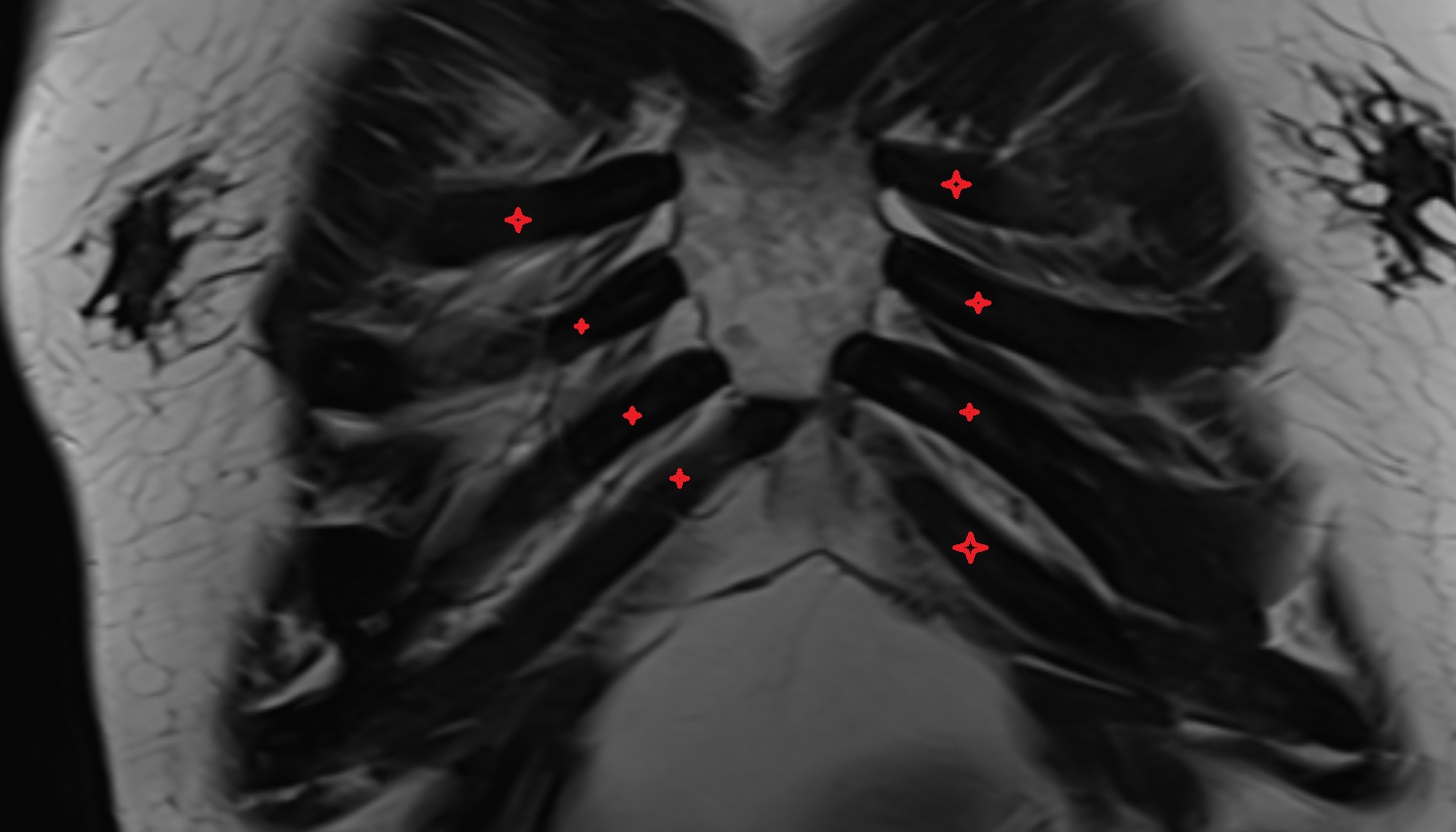 Costal cartilage  anatomy MRI CORONAL  image -img-00000-00000