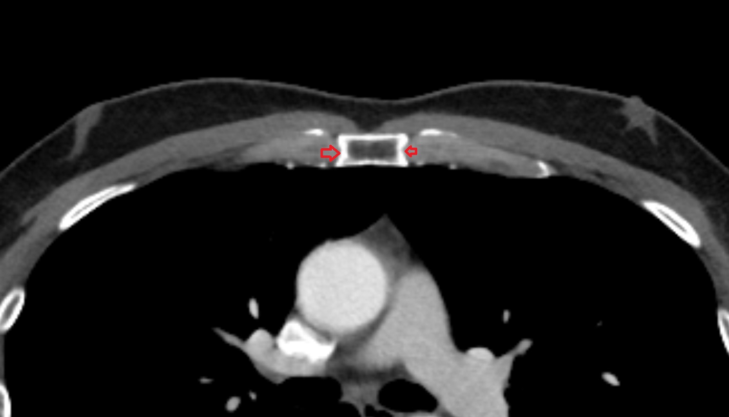 Costal notches  anatomy CT axial  image -img-00000-00000