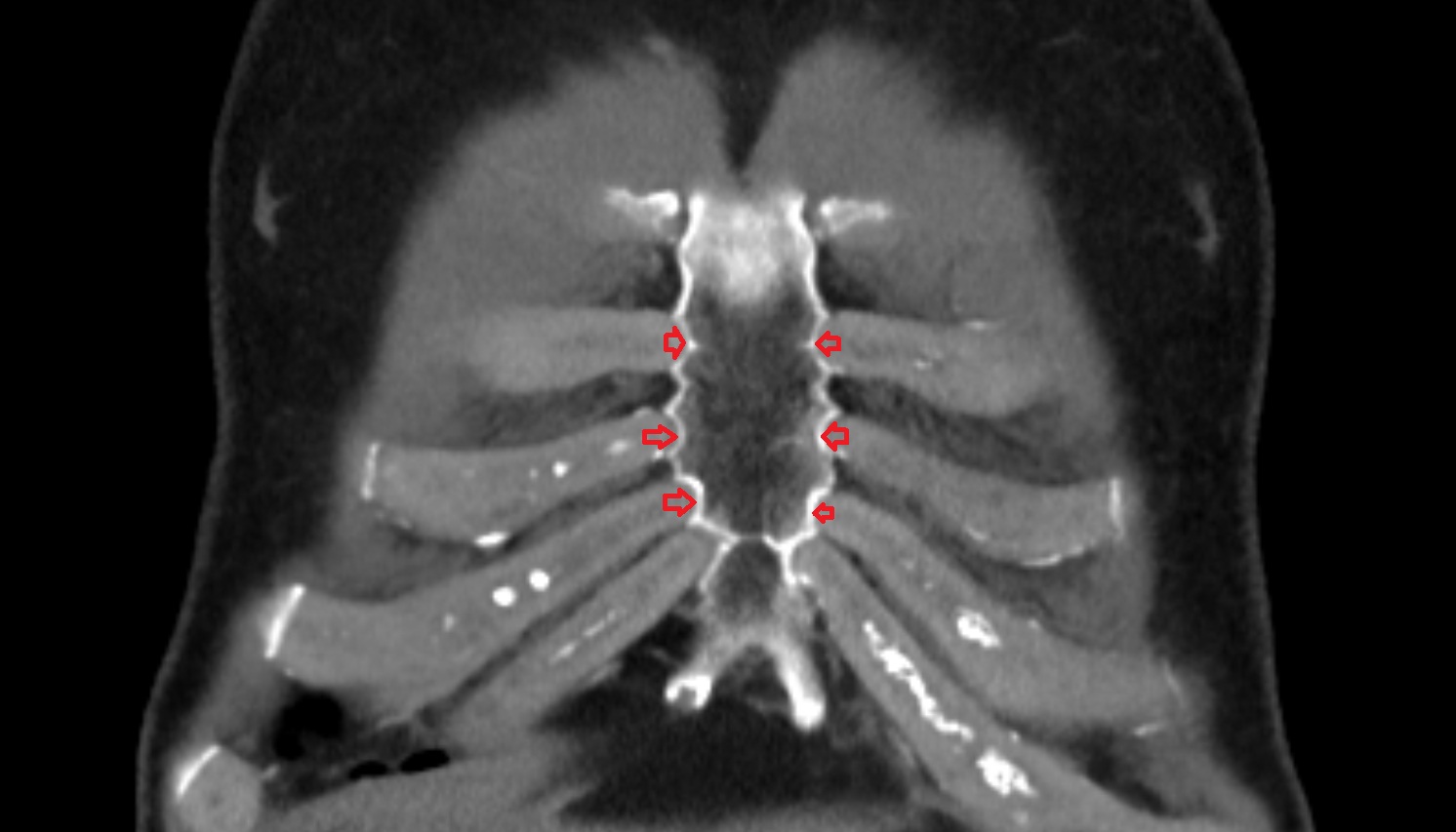 Costal notches  anatomy CT coronal  image -img-00000-00000