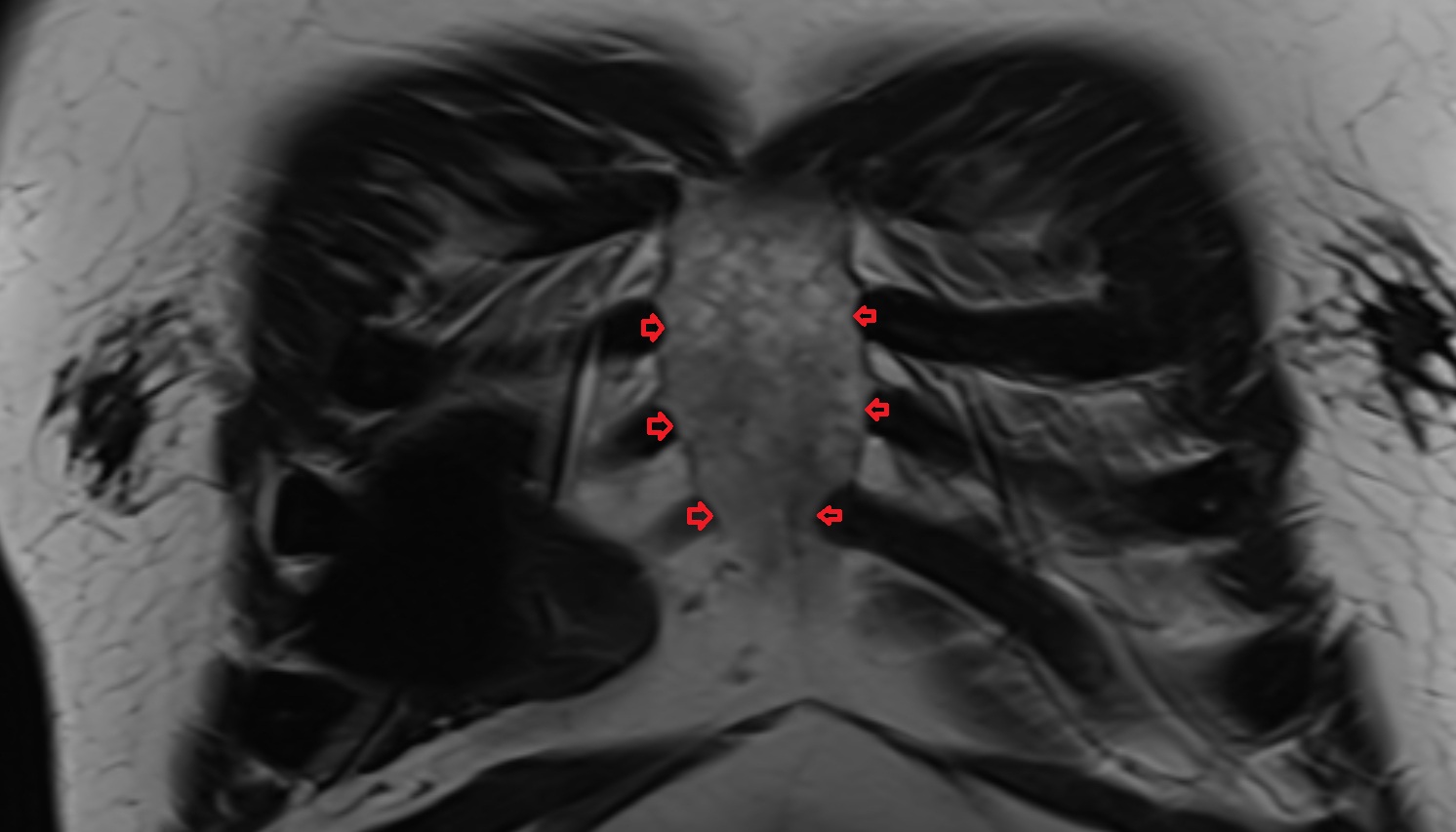 Costal notches  anatomy MRI CORONAL  image -img-00000-00000