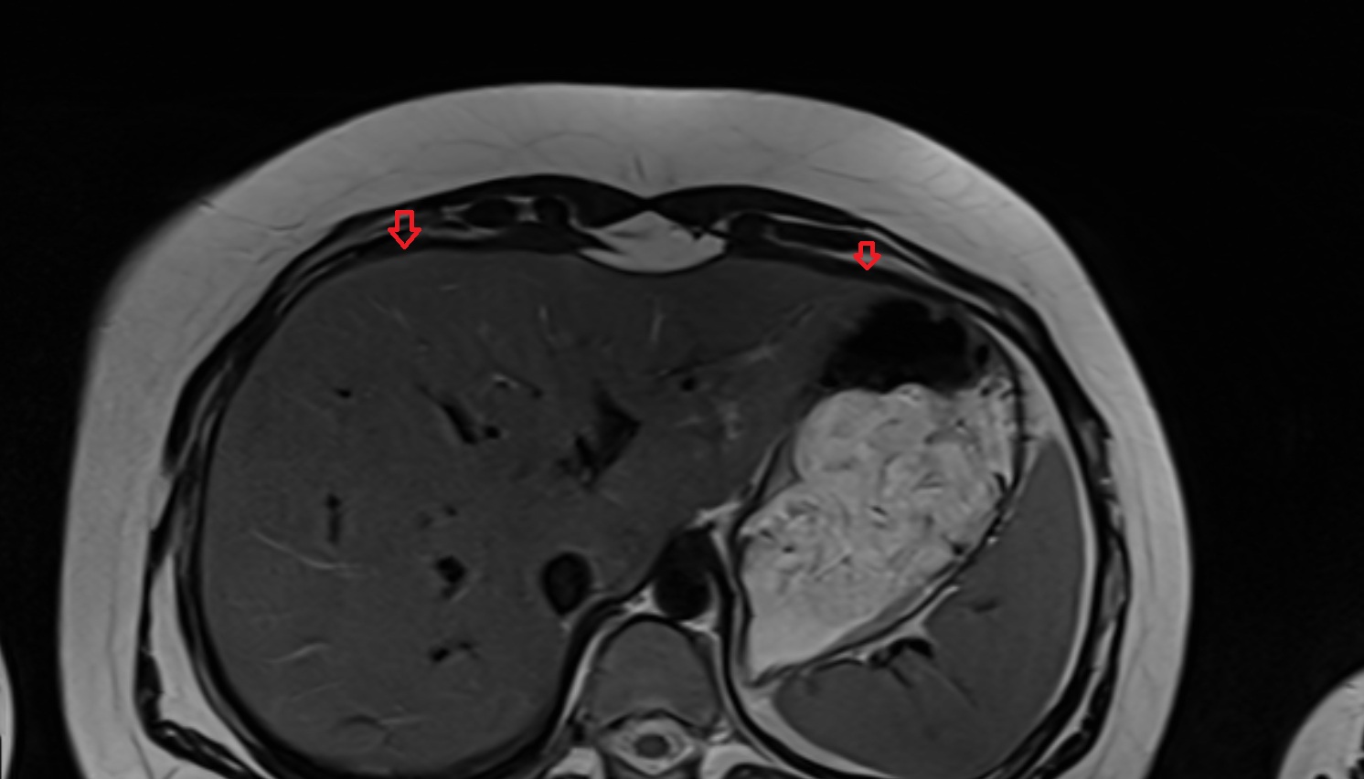 Costal part of diaphragm MRI axial  image -img-00000-00000