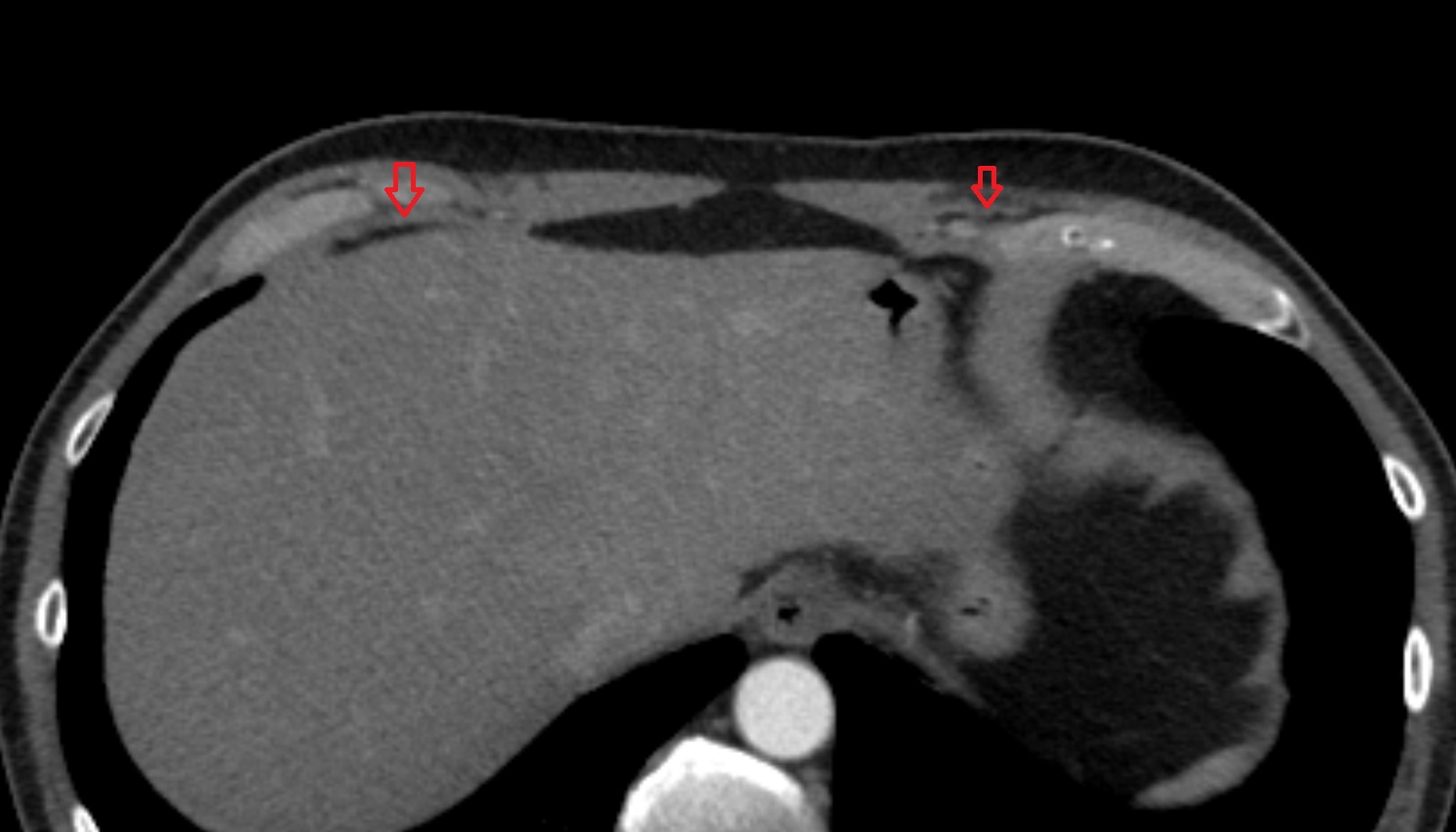 Costal part of diaphragm ct axial  image -img-00000-00000