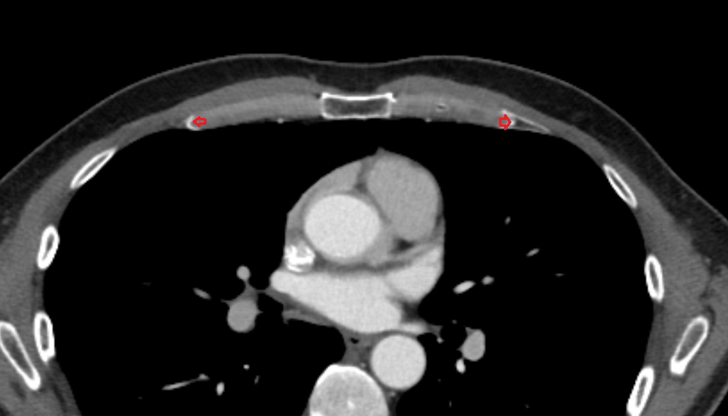 Costochondral joints  anatomy CT axial  image -img-00000-00000