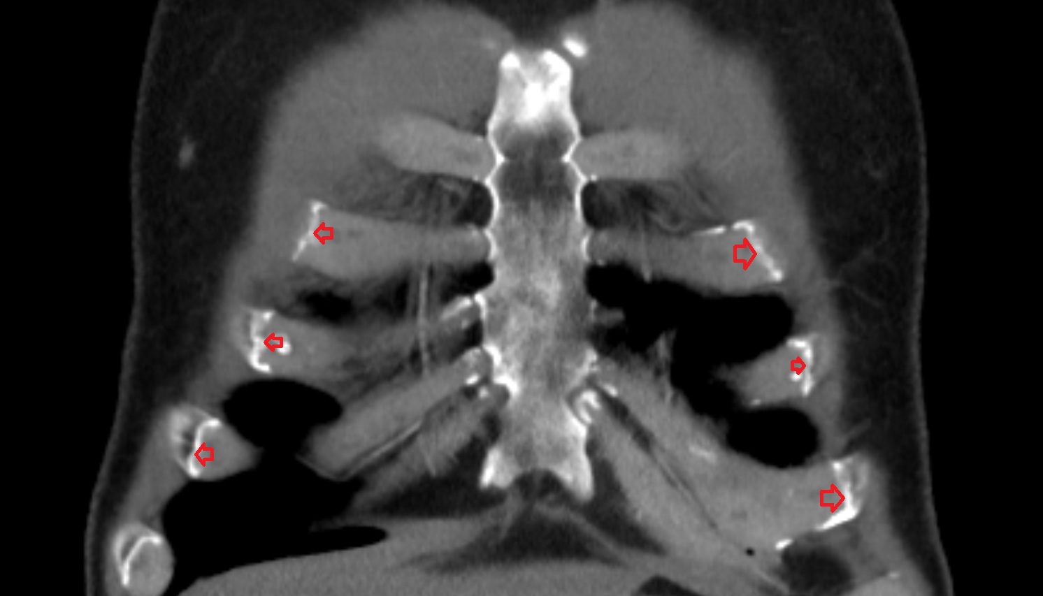 Costochondral joints  anatomy CT coronal  image -img-00000-00000