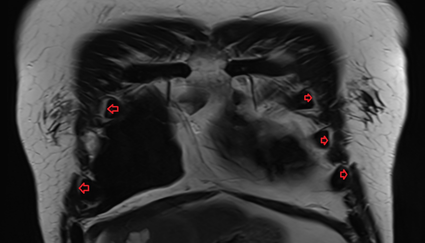Costochondral joints  anatomy MRI coronal  image -img-00000-00000