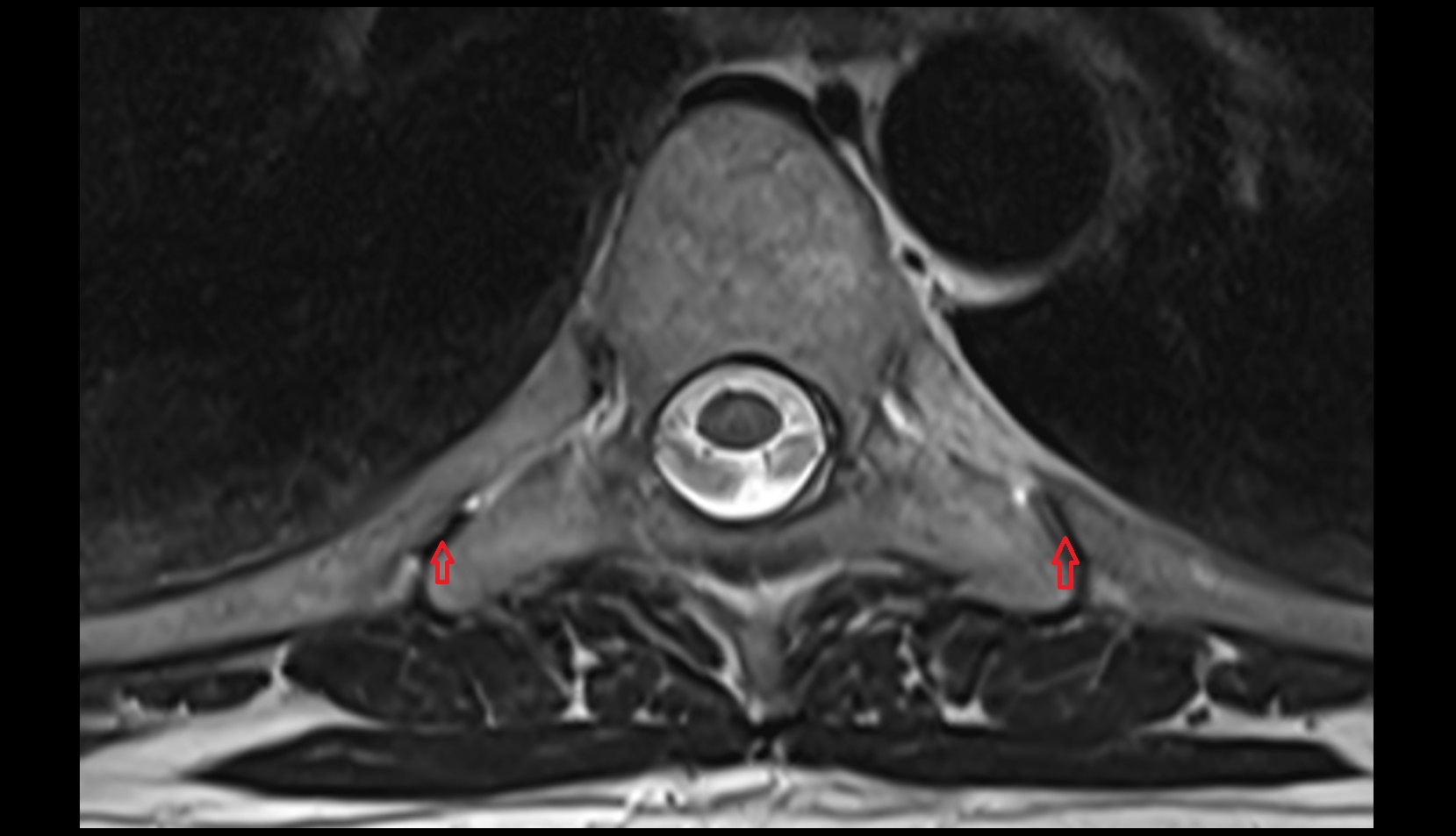 Costotransverse joint mri