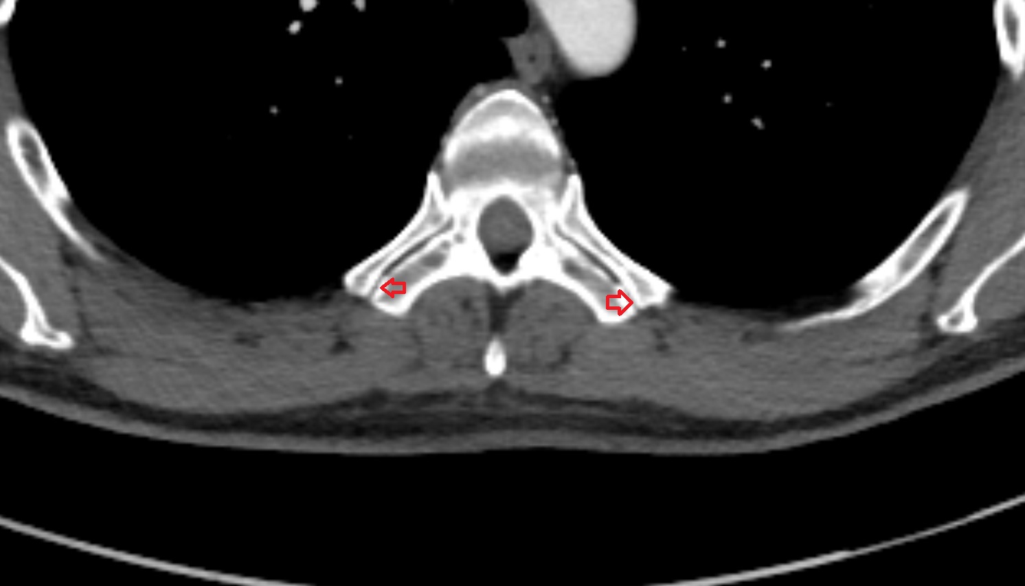 Costotransverse joint  anatomy CT axial  image -img-00000-00000
