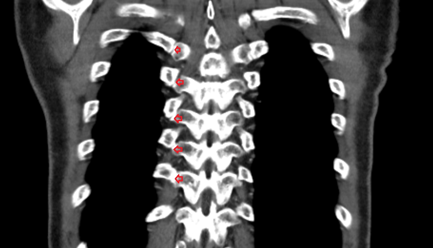 Costotransverse joint  anatomy CTcoronal  image -img-00000-00000