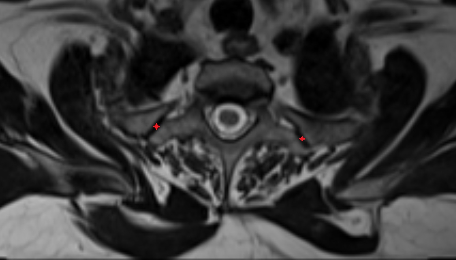 Costotransverse joint  mri axial image -img-00000-00000