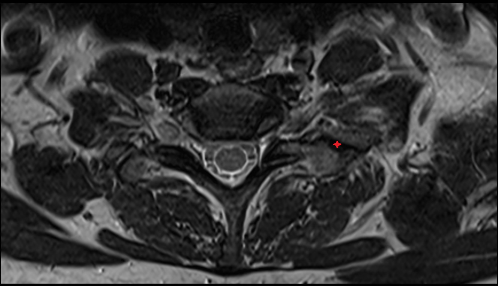 Costotransverse joint mri axial image