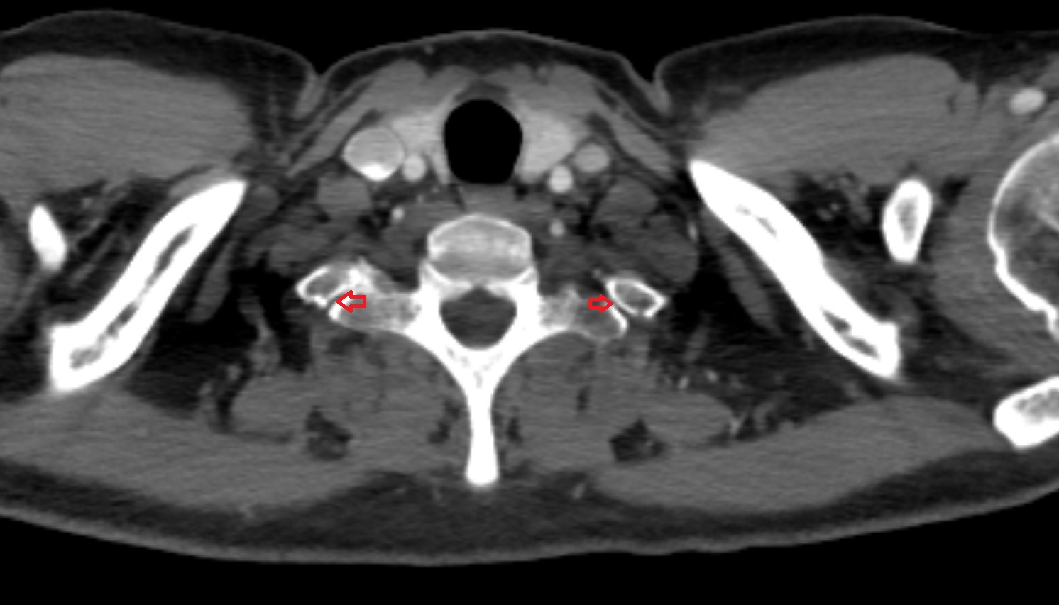 Costotransverse joint of first rib CT axial  image -img-00000-00000