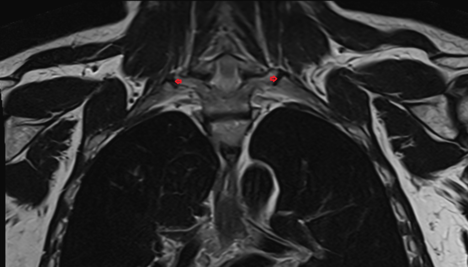 Costotransverse joint of first rib MRI coronal  image -img-00000-00000