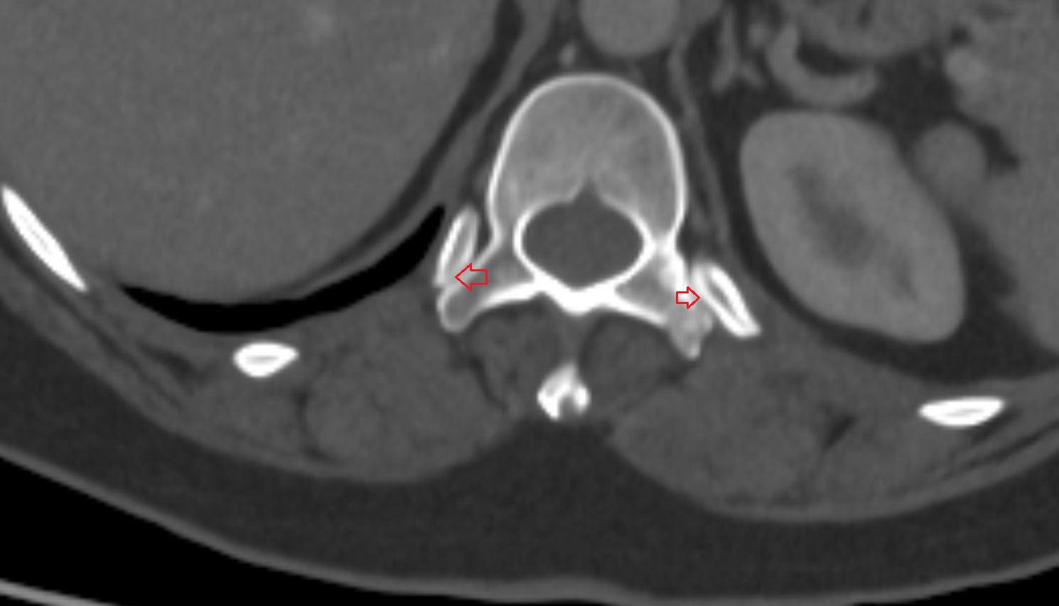 Costotransverse joint of twelfth rib CT AXIAL   anatomy  image-img-00000-00000