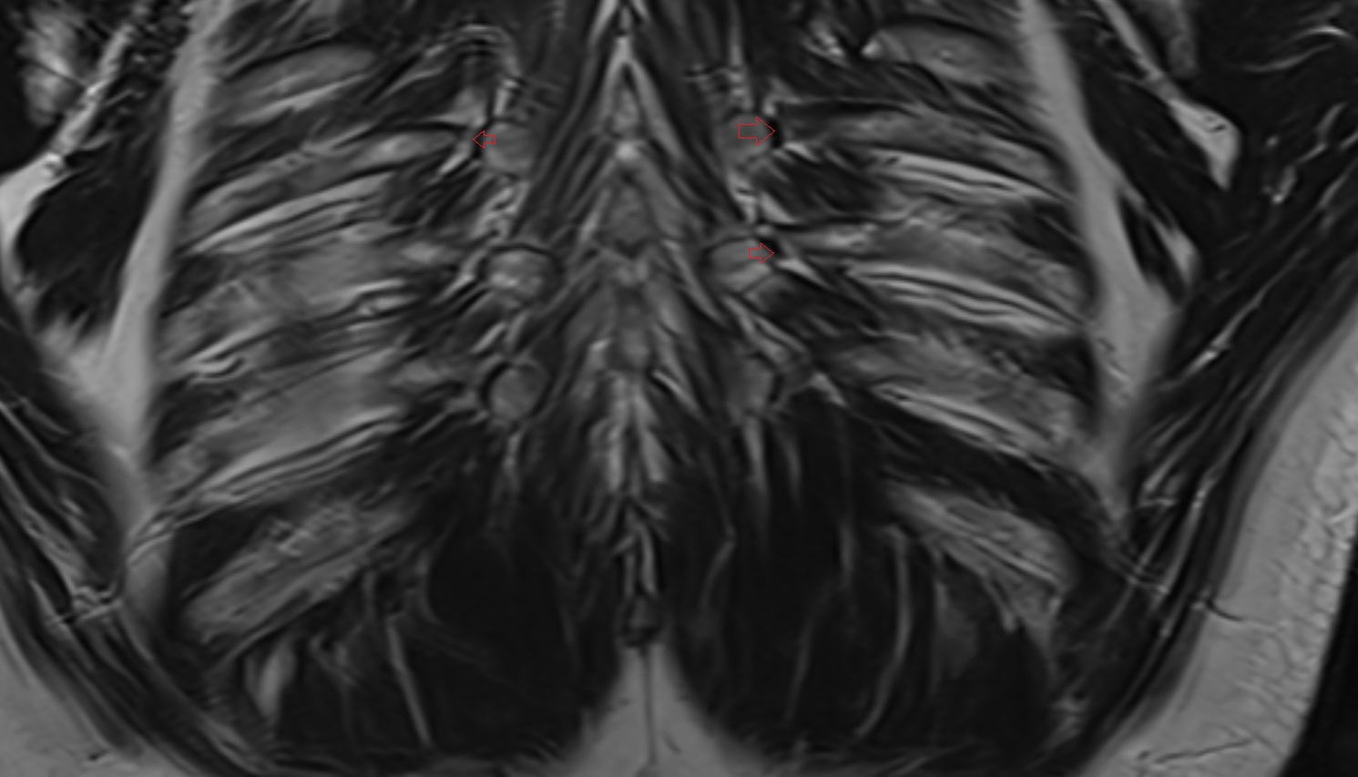 Costotransverse ligament mri  coronal  image -img-00000-00000