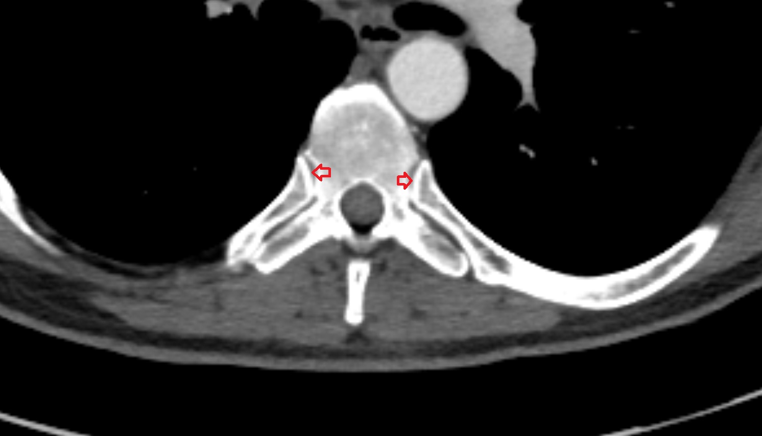 Costovertebral joint  anatomy CT axial  image -img-00000-00000