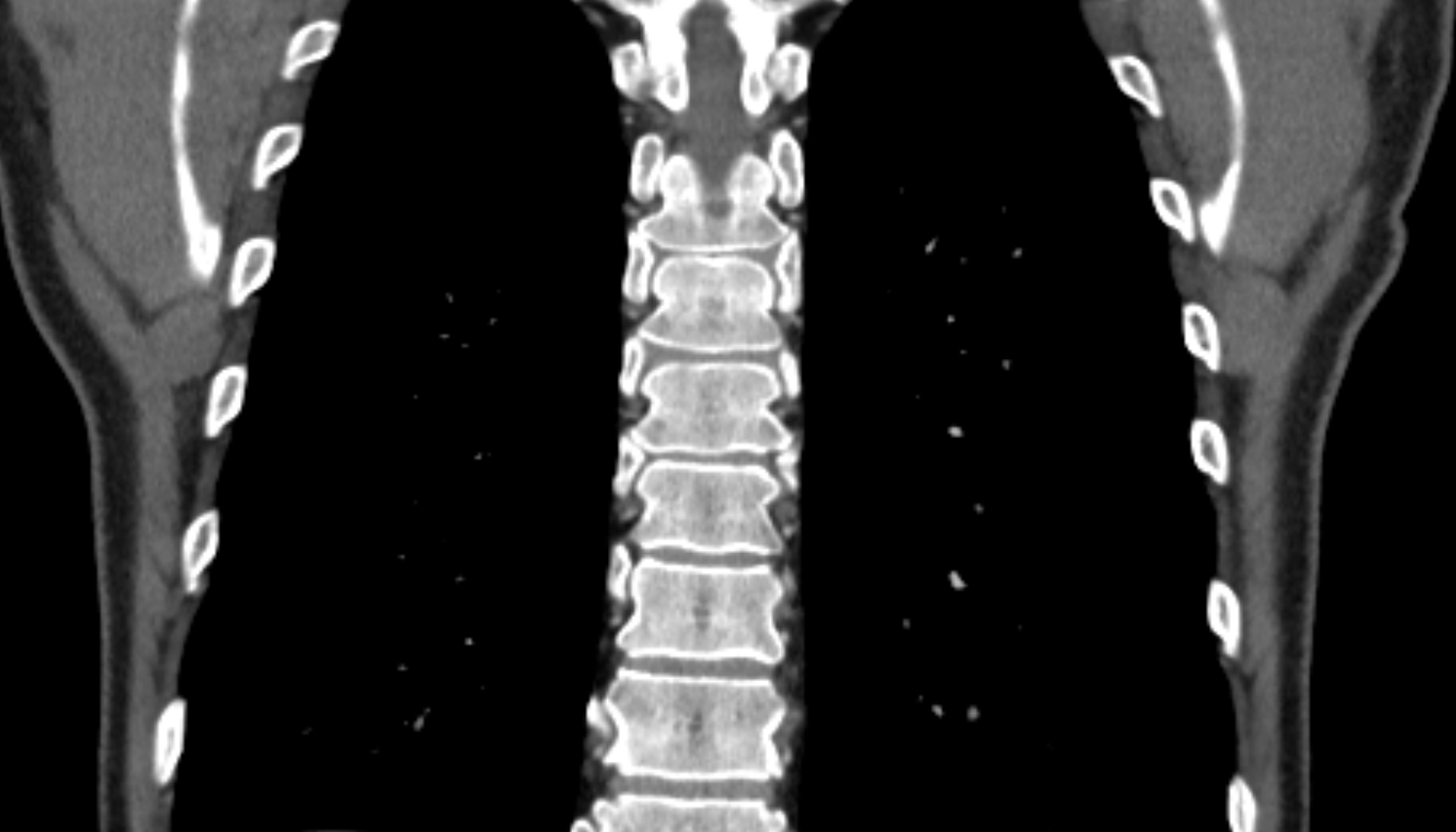 Costovertebral joint  anatomy CTcoronal  image -img-00000-00000