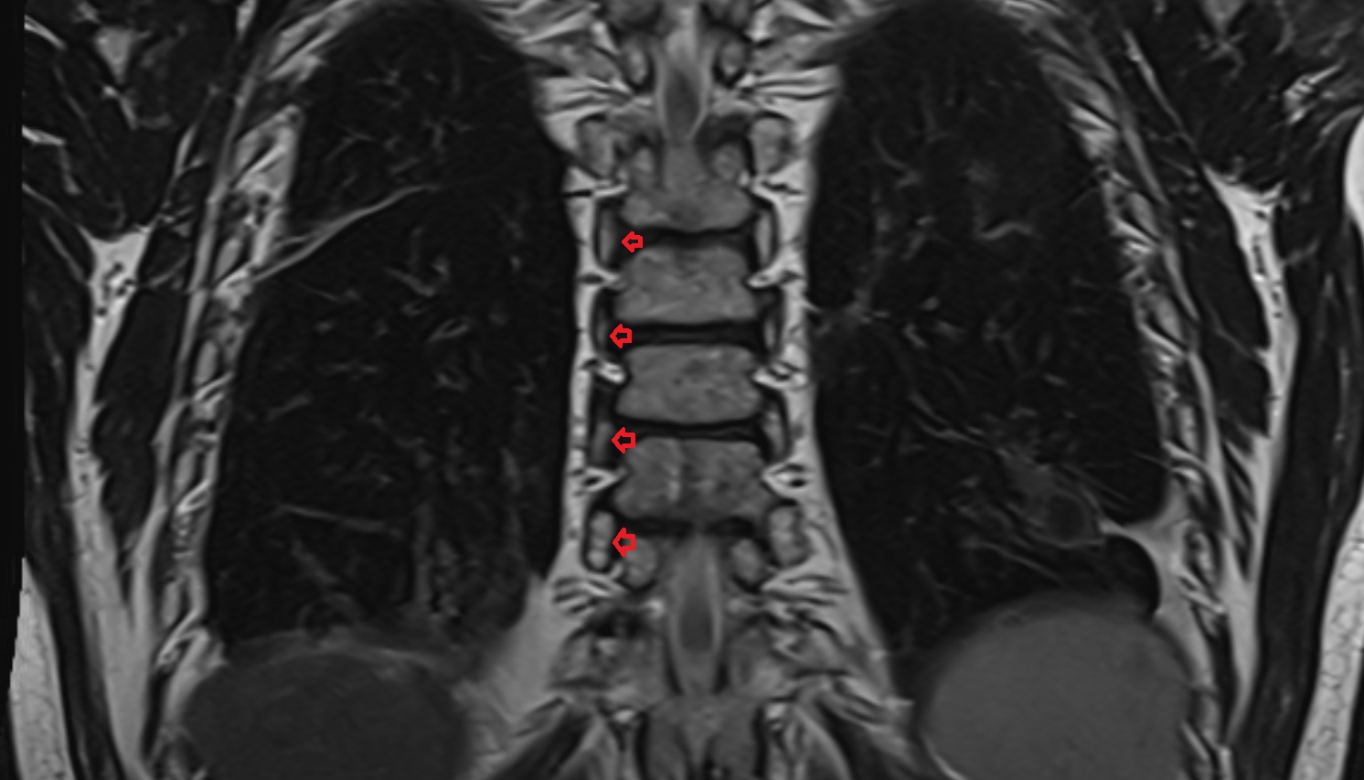 Costovertebral joint   anatomy MRI coronal  image -img-00000-00000