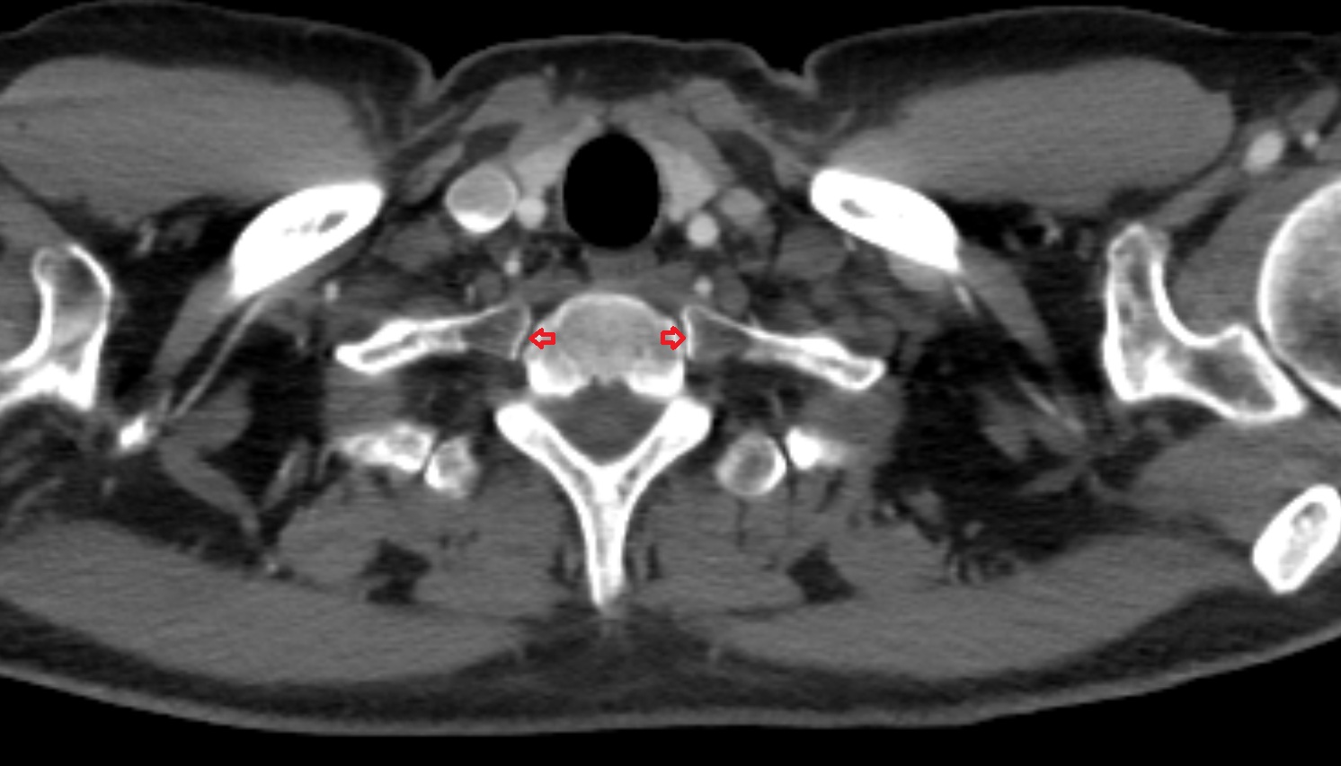 Costovertebral joint of first rib (rib head joint) CT axial  image -img-00000-00000