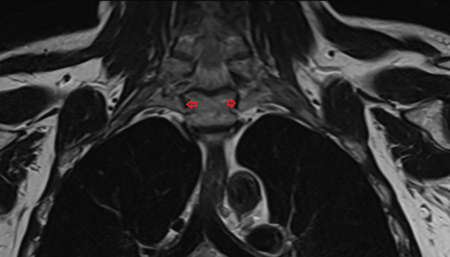Costovertebral joint of first rib (rib head joint) MRI coronal  image -img-00000-00000