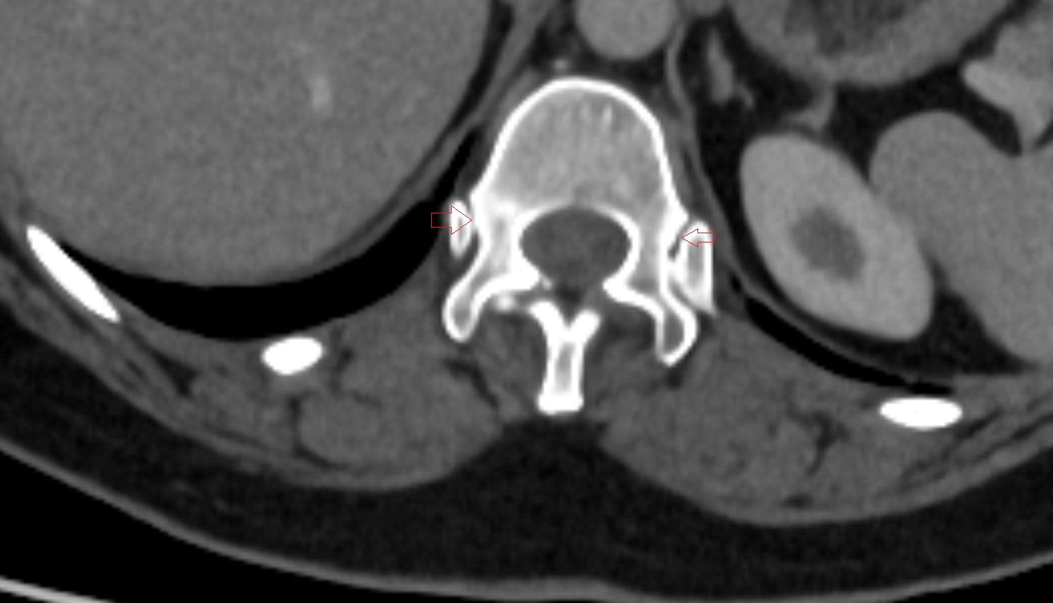 Costovertebral joint of twelfth rib CT AXIAL   anatomy  image-img-00000-00000