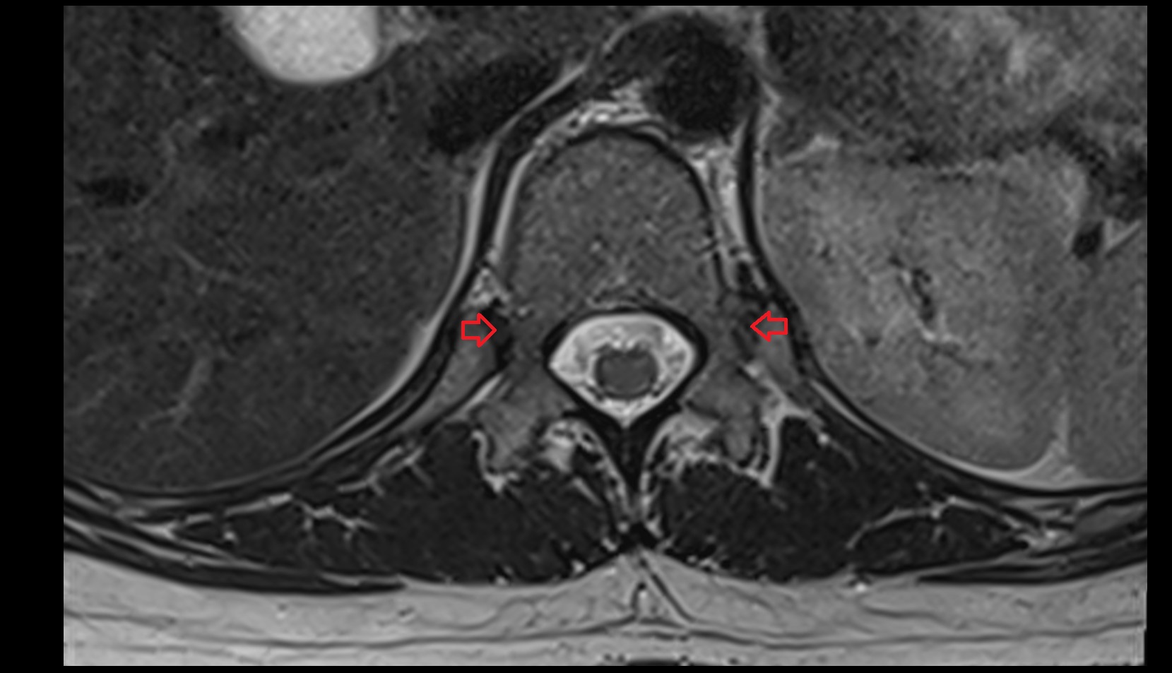 Costovertebral joint of twelfth rib mri axial