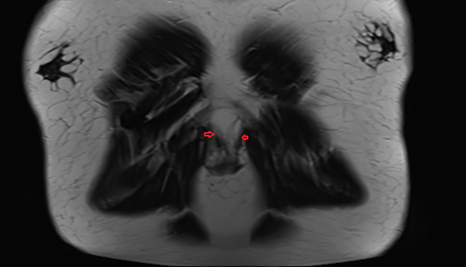 Costoxiphoid ligament coronal mri  image-img-00000-00000