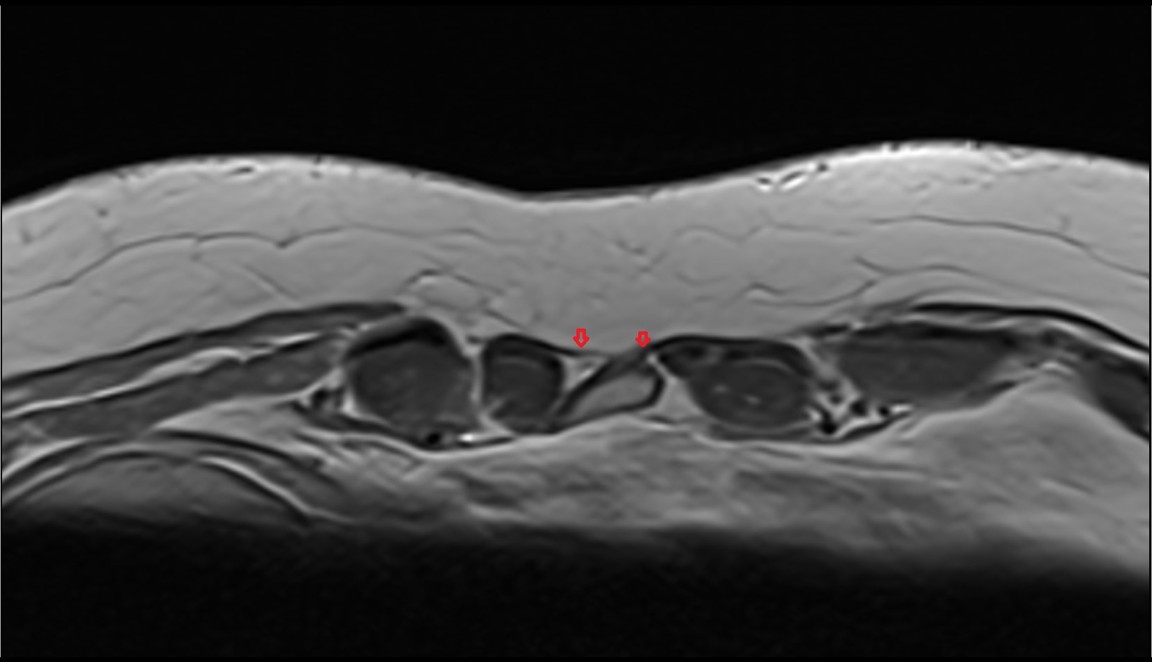 Costoxiphoid ligament mri axial
