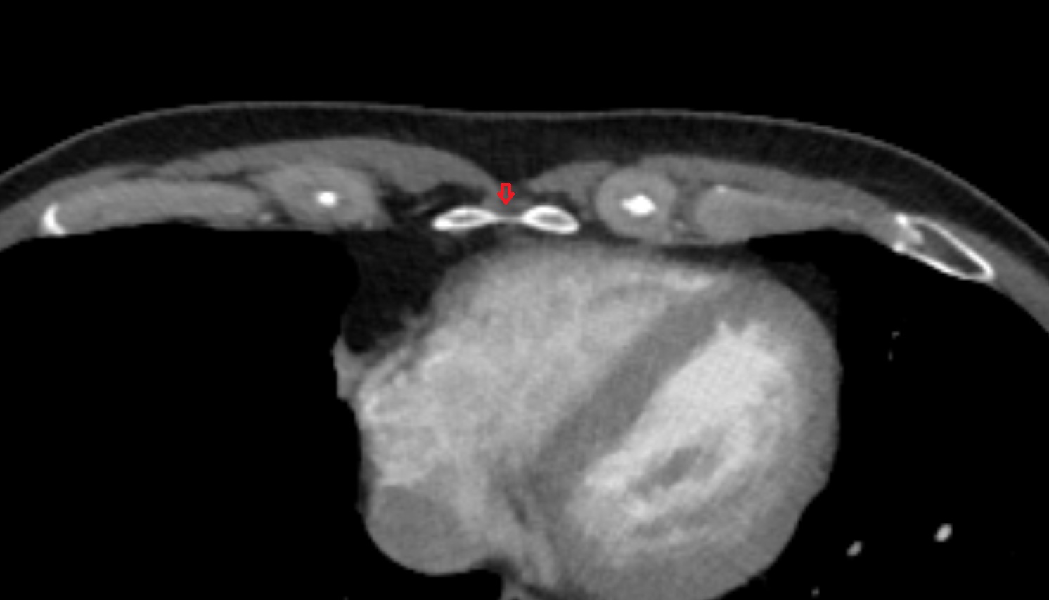 Costoxiphoid ligaments  anatomy CT AXIAL  image -img-00000-00000