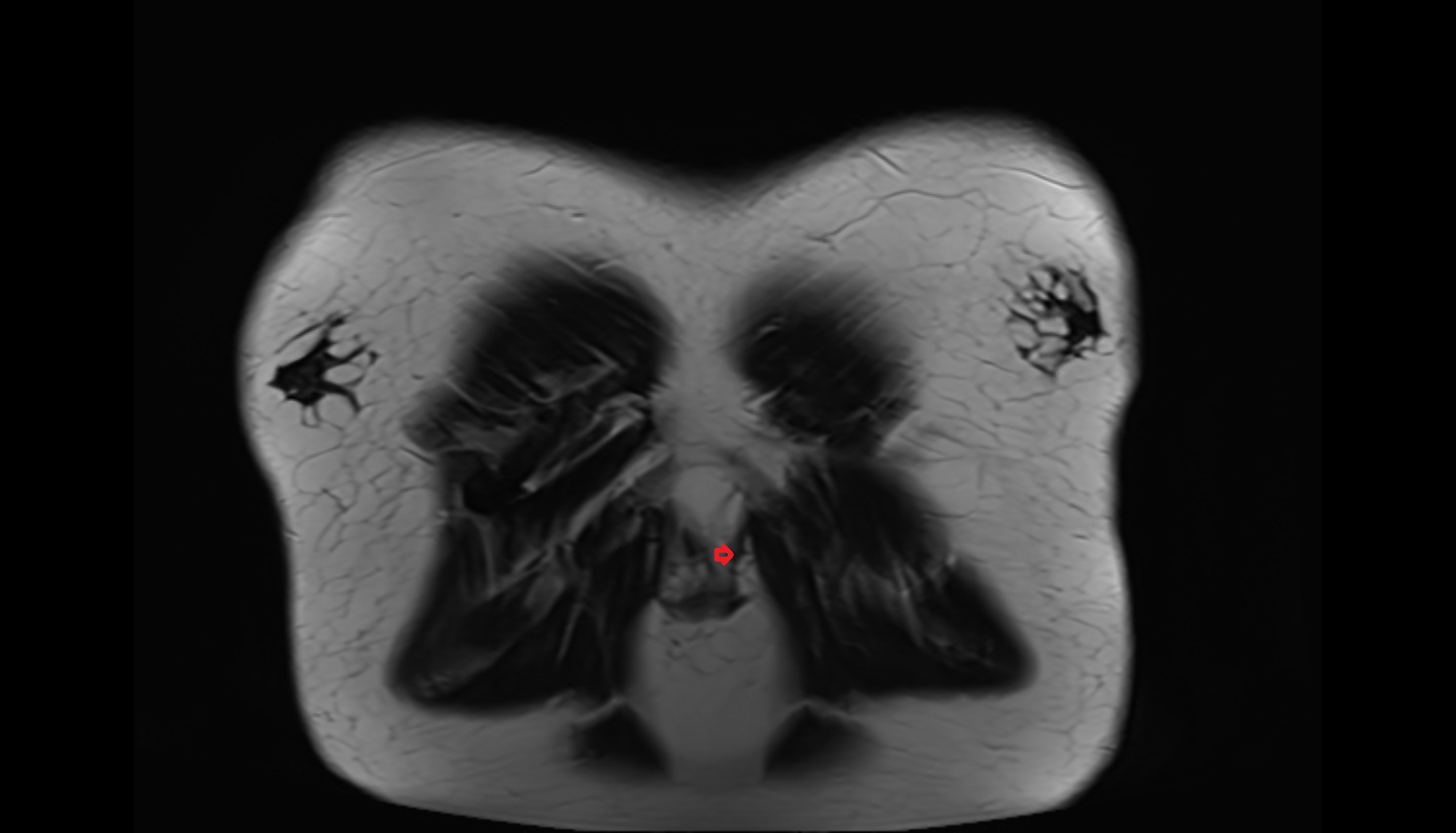 Costoxiphoid ligaments  anatomy MRI coronal  image -img-00000-00000