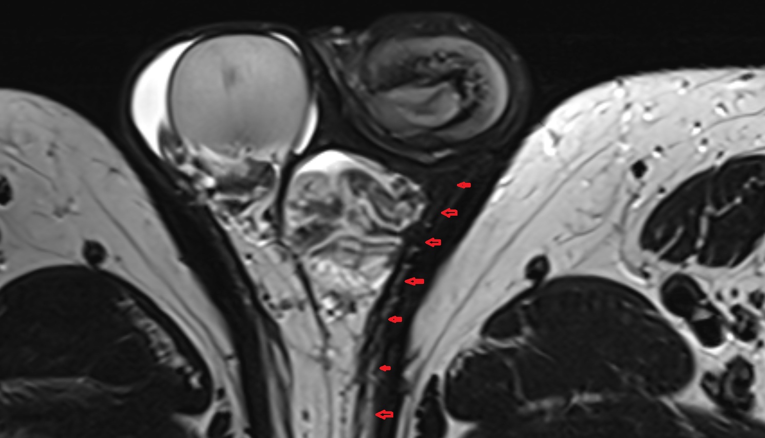Cremaster fascia  mri axial  anatomy  image-img-00000-00000_00001