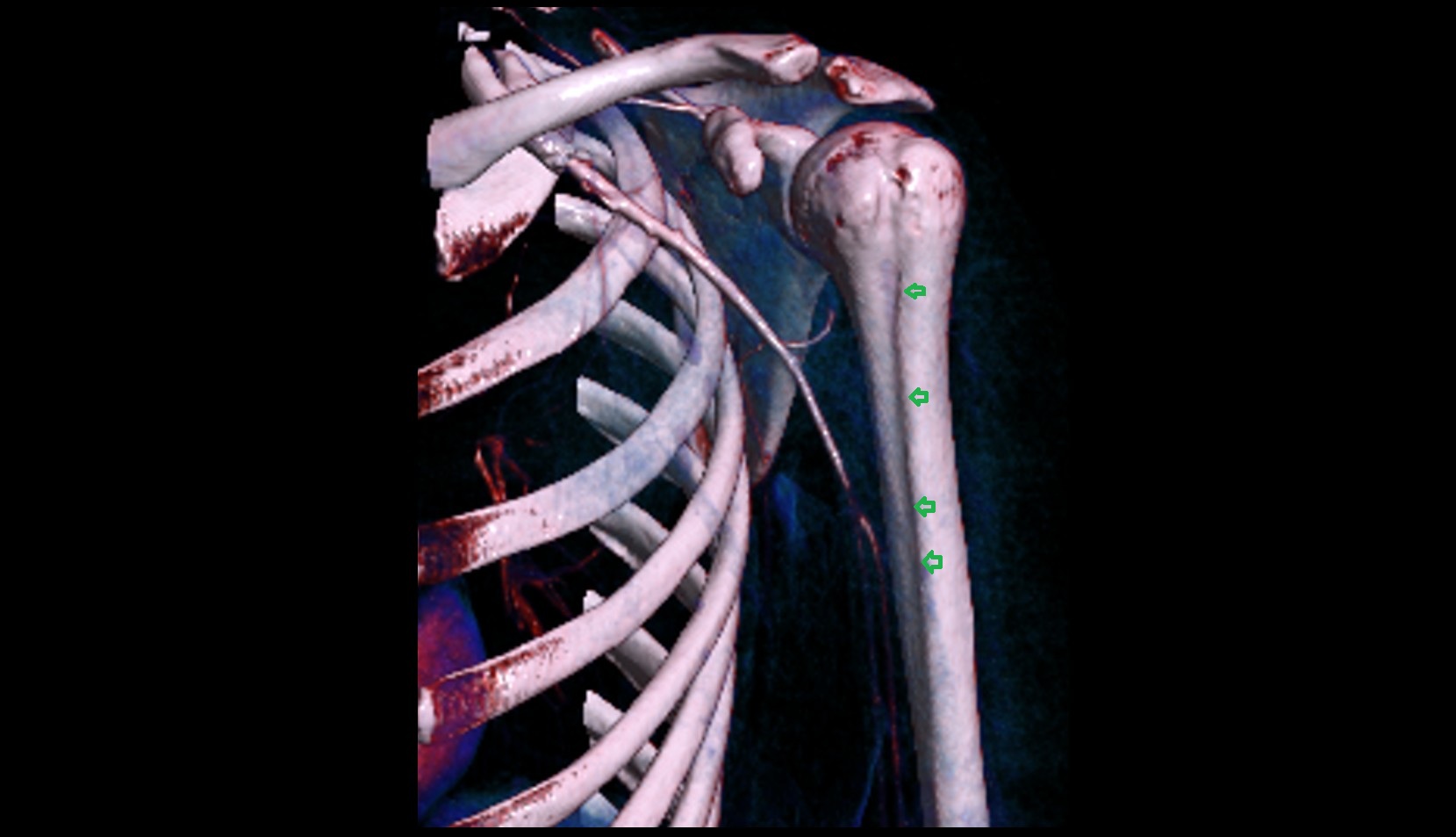 Crest of greater tubercle