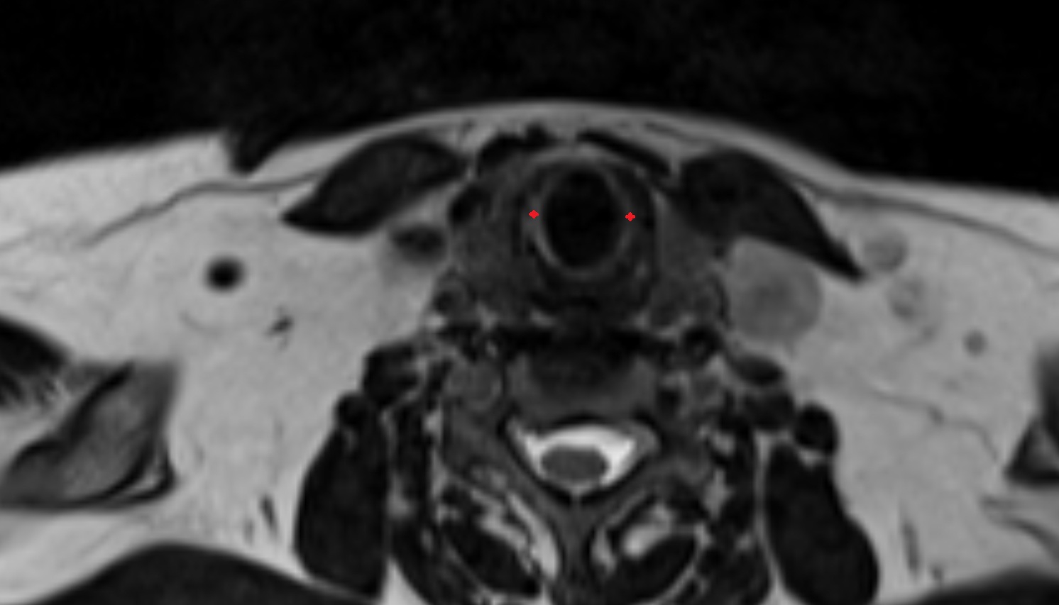 Cricoid cartilage  mri axial image -img-00000-00000_00001