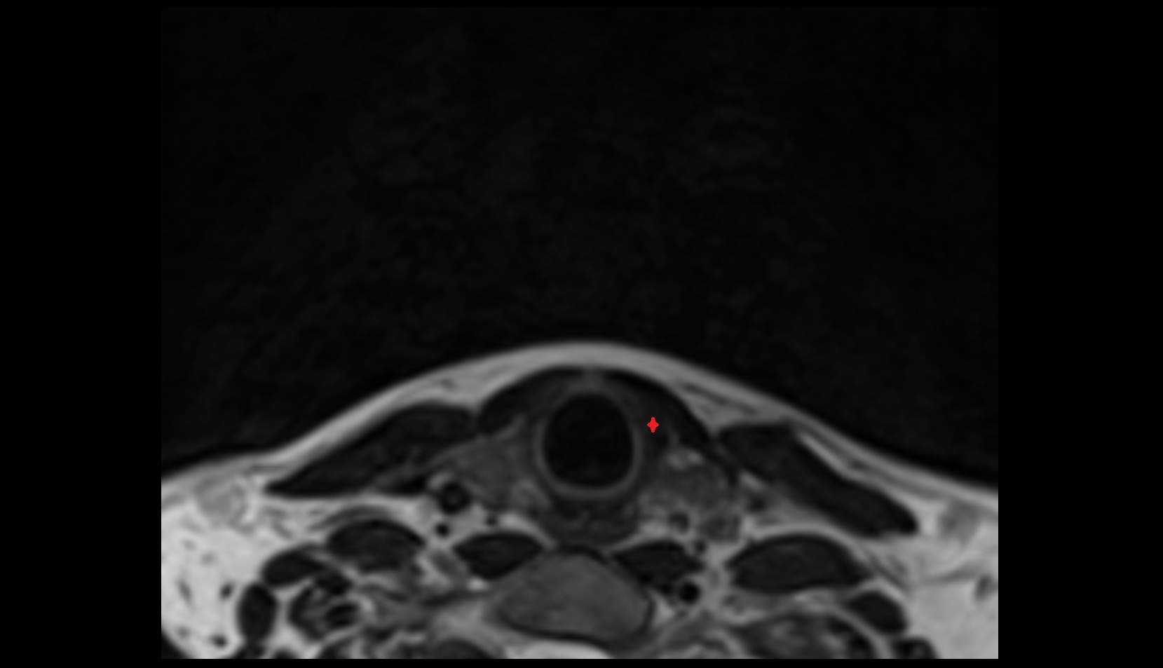 Cricothyroid muscle MRI AXIAL IMAGE