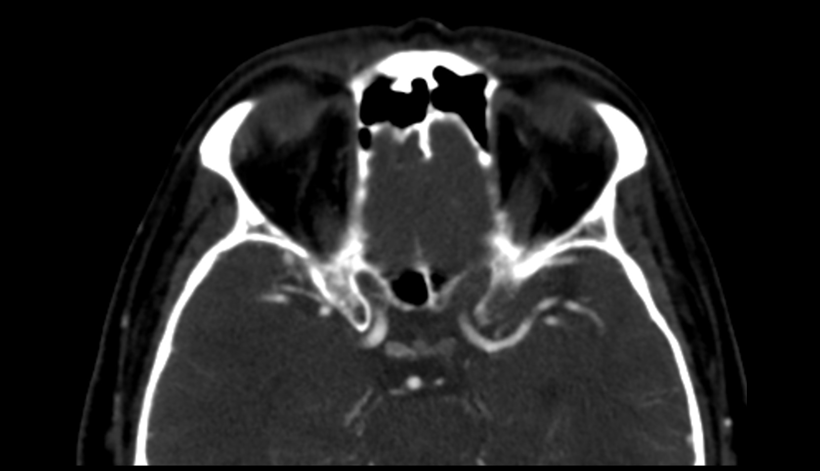 Crista galli CT AXIAL IMAGE