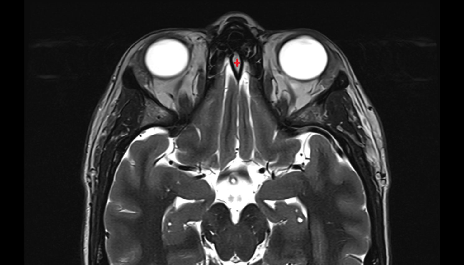 Crista galli MRI axial  image-img-00000-00000