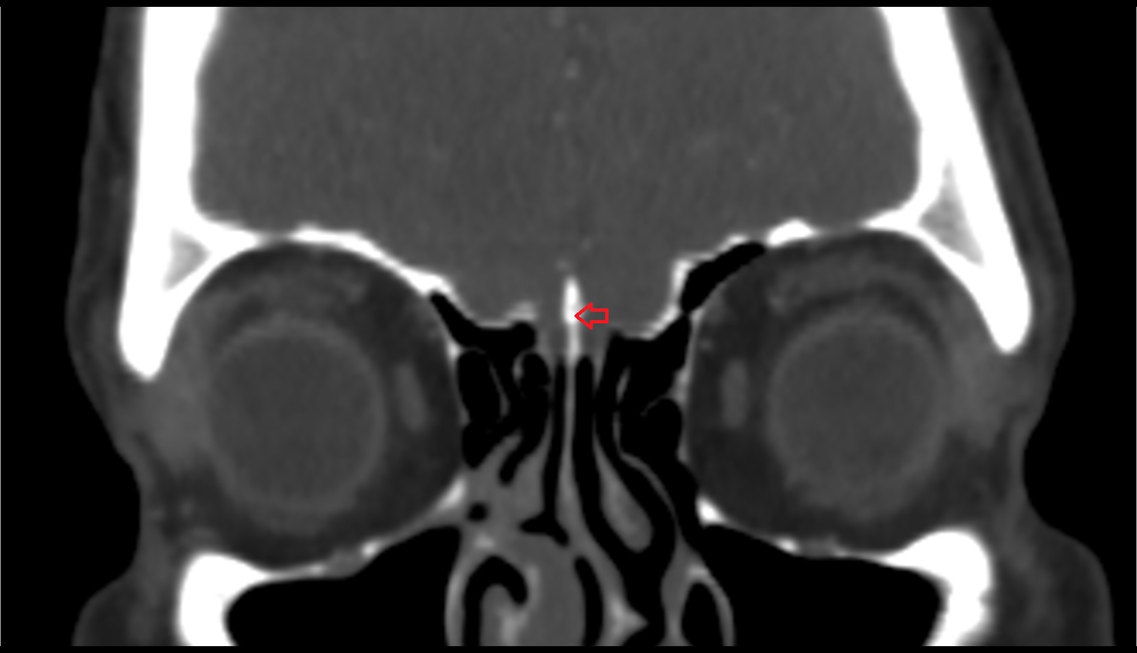 Crista galli ct coronal