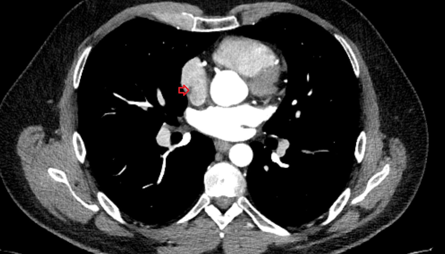 Crista terminalis  anatomy CT axial  image -img-00000-00000