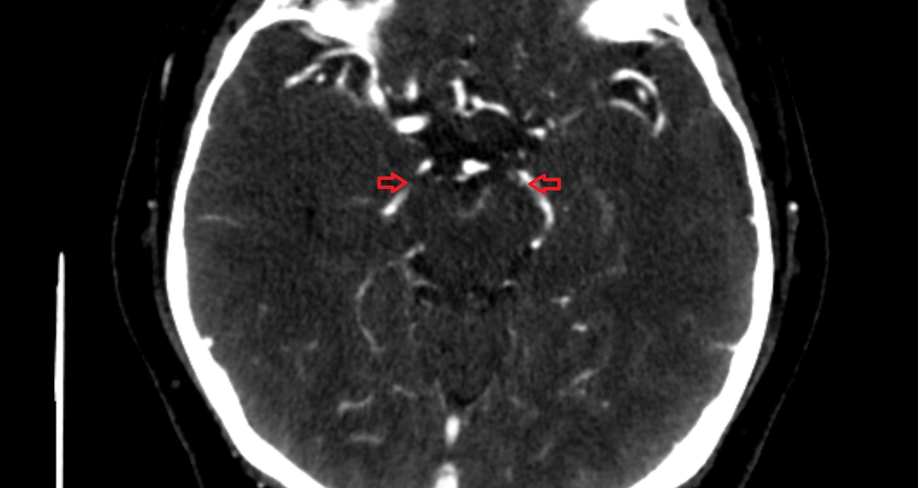 Crural cistern CT axial anatomy image -img-00001-00001