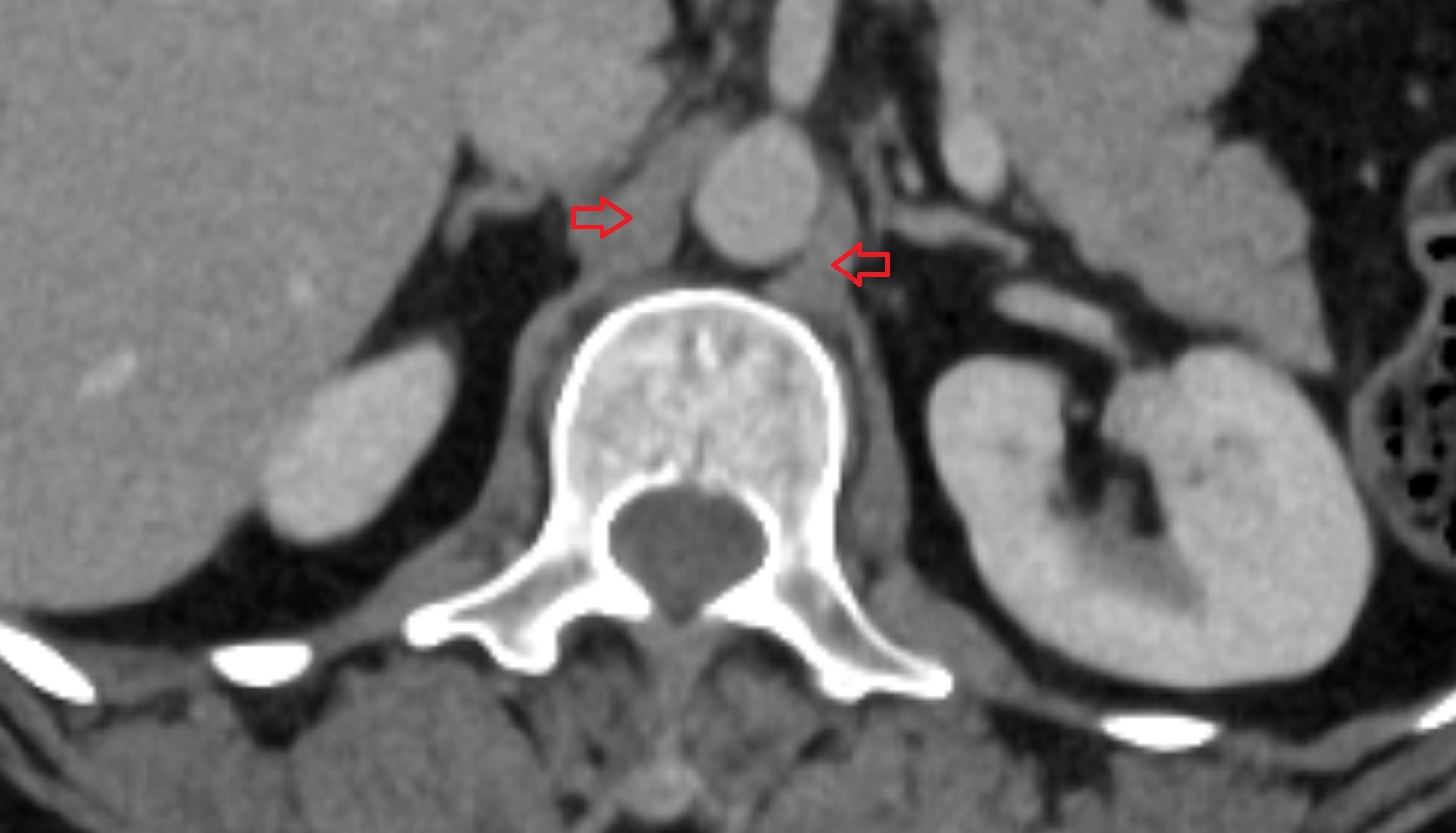 Crural part of diaphragm  CT axial  image anatomy  image -img-00000-00000