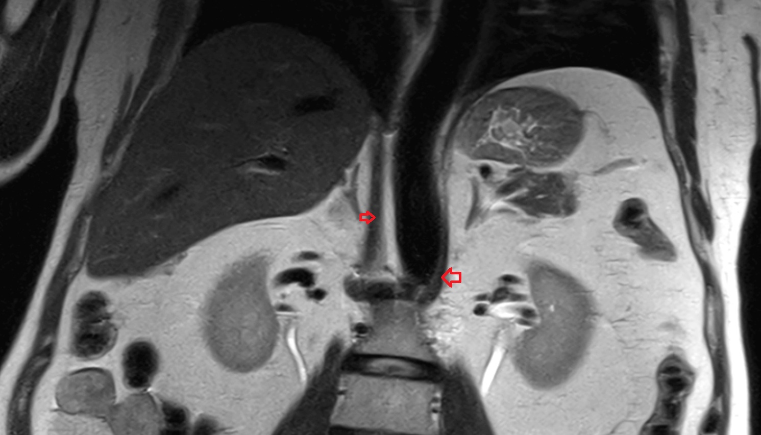 Crural part of diaphragm  MRI coronal  image anatomy  image -img-00000-00000