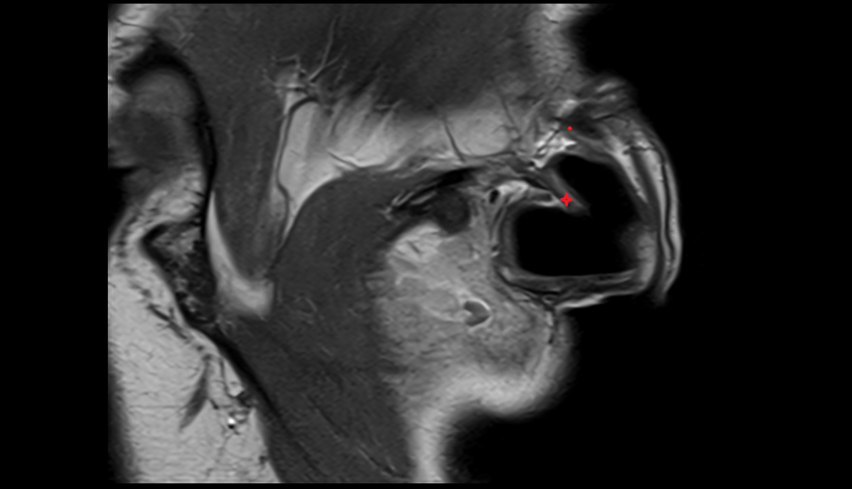 Crus helix of ear MRI images