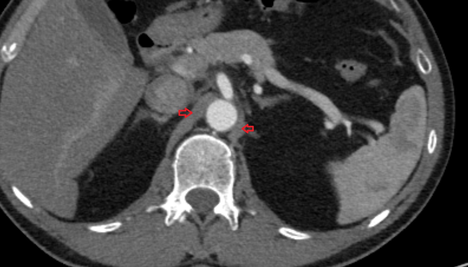 Crus of diaphragm  anatomy CT axial image -img-00000-00000