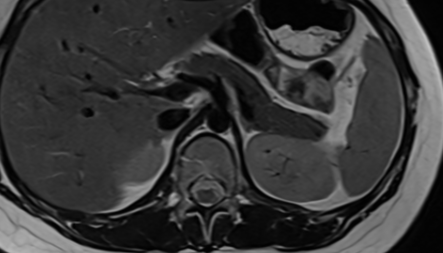 Crus of diaphragm  anatomy MRI axial image -img-00000-00000