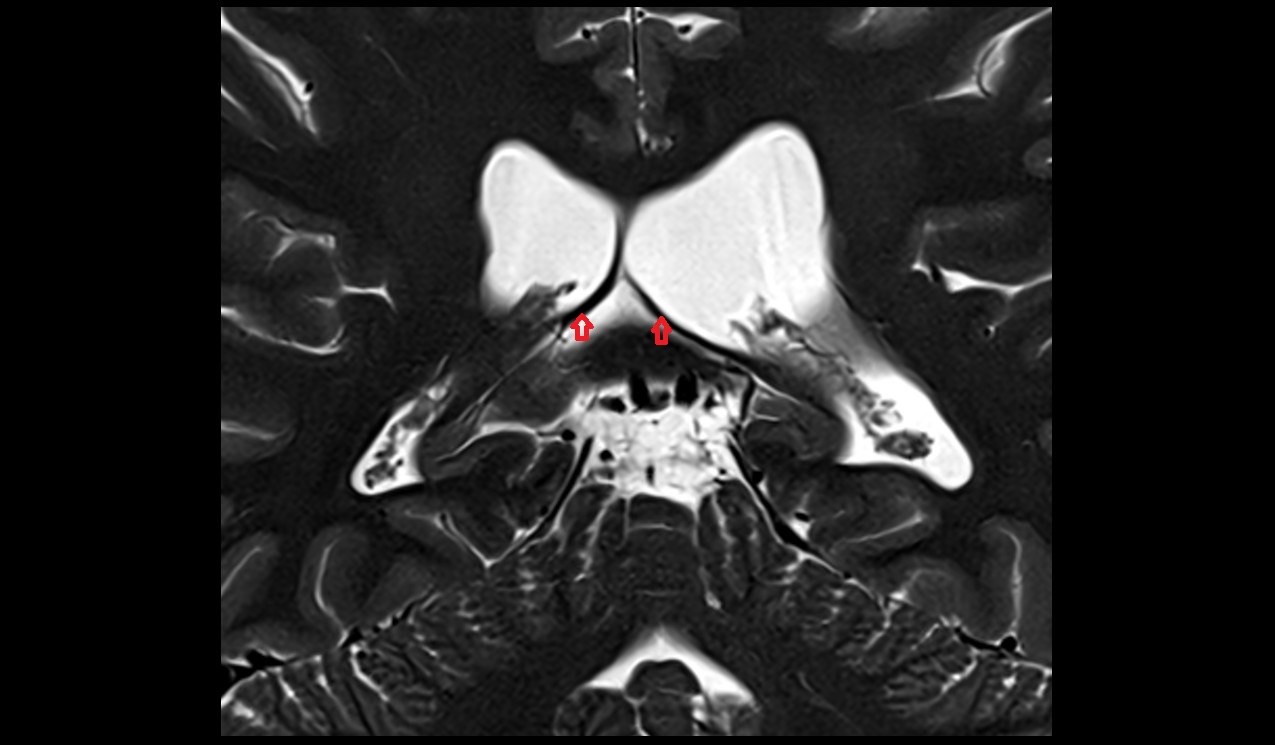 Crus of fornix mri 3t coronal image